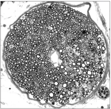 Fig 1. Coronal semi-thick section of a sciatic nerve fascicle of a Cx32  KO mouse. Edema at the right side of the section