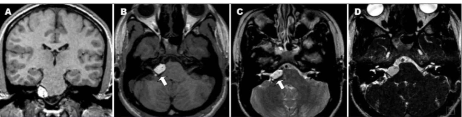 Fig 1. Patient 1. Coronal [A] and axial [B] T1-weighted MR image show a hyperintense mass in the right CPA involving the VII and VIII cranial  nerves