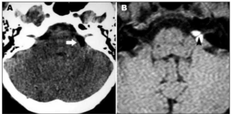 Fig 2. Patient 1. [A Coronal STIR MR image demonstrates the lipoma  with very low signal intensity due to the fat suppression