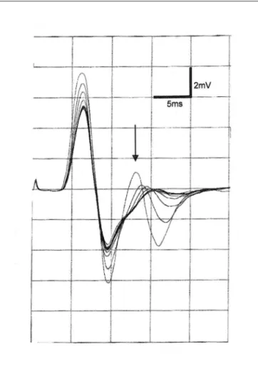 Fig 1. Classical electrophysiological features of end-plate AChE de- de-iciency: [A] repetitive compound muscle action potential (CMAP)  evoked by single stimulation applied to median nerve; [B] repetitive  CMAP disappearing when single nerve stimulation w