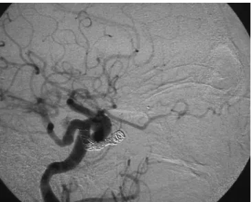 Fig 2. Patient 1. Post-therapeutic angiogram demonstrating total oc- oc-clusion of the istula, with added coils inside the cavernous sinus.