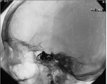 Fig 4. Patient 2. Post-embolization aspect, with a dense coil cast in- in-side the cavernous sinus.