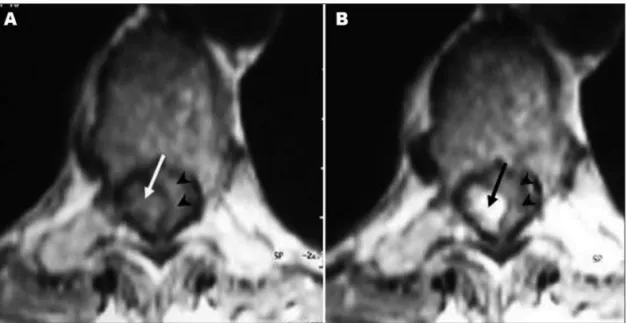 Fig 1. Axial MRI. [A] T1-weighted image reveals an isointense tumor (arrow) clearly separated from the surface of the  spinal cord (arrowheads)