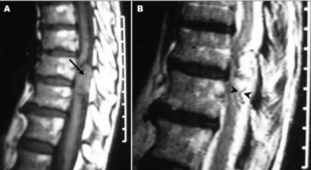 Fig 2. Sagittal MRI. [A] T1-weighted image shows the tumor (arrow) at T10–T11. [B] T2-weighted image reveals an area  of low signal, indicating low void due to abnormal vascular structure (arrowheads).