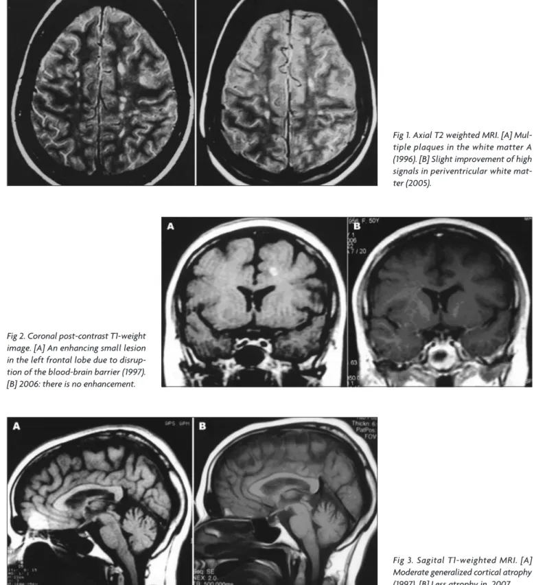 Fig 2. Coronal post-contrast T1-weight  image. [A] An enhancing small lesion  in the left frontal lobe due to  disrup-tion of the blood-brain barrier (1997)