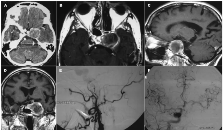 Fig 2. [A] CT scan showing giant aneurysm of left ICA, partially occluded by thrombosis and with bone erosion in a female 84-year-old patient  with headache, retro bulbar pain, full III cranial nerve, left IV, VI, V1 and V2