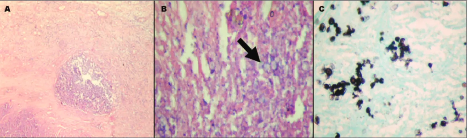 Fig 2. Histopathological analysis of the mass ressected with the haematoxilin and eosin staining [A and B] and Grocott staining [C]