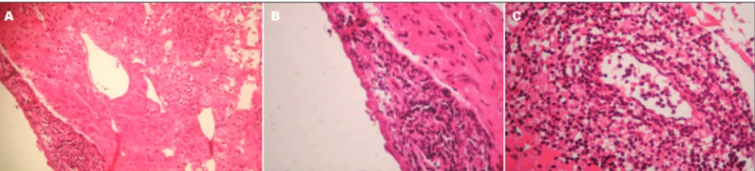 Fig 2. Pathology patterns. [A] HE, Meningeal and brain tissue iniltration; [B] Meningeal lymphocyte iniltration; [C] Perivascular inlammato- inlammato-ry iniltrates.