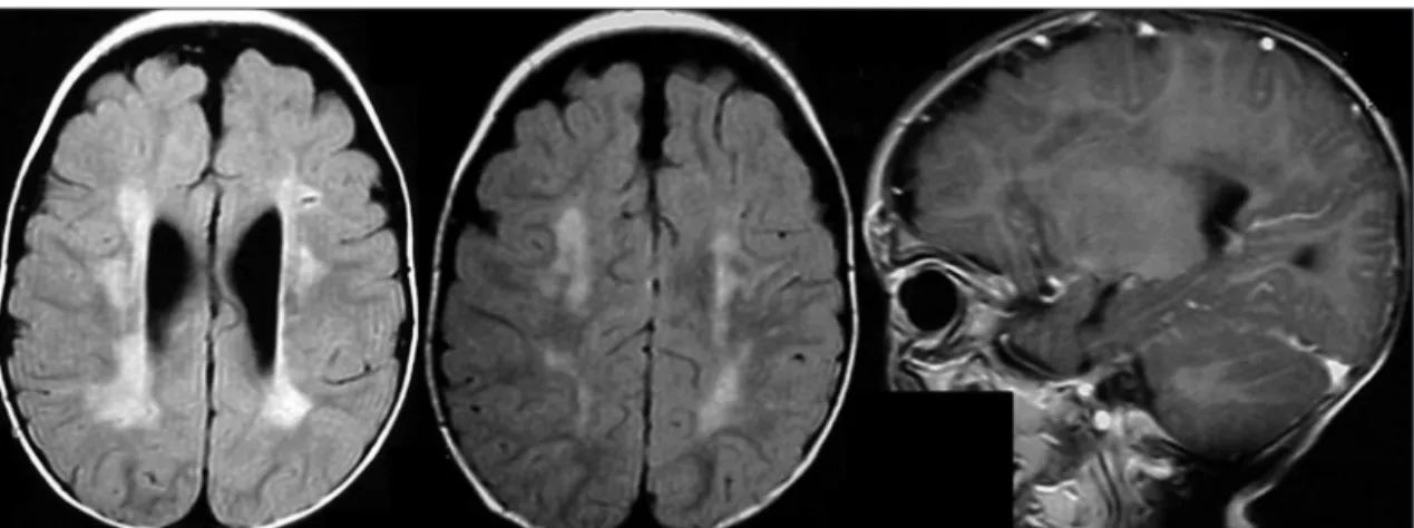 Fig 1. MRI examination at 21 months of age. Axial FLAIR (luid-attenuated inversion recovery) and sagital T1-weight- T1-weight-ed post gadolinium (MR contrast agent)