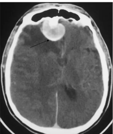Fig 3. CT with contrast showing the meningioma and homolateral  subdural haematoma area with higher capitation (black arrow).