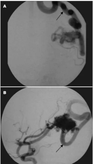 Fig 2. Angiogram of a 34-year-old female patient showing left tem- tem-poro-parietal AVM with single draining vein (arrows) in  anteropos-terior position [A] and in lateral view [B].