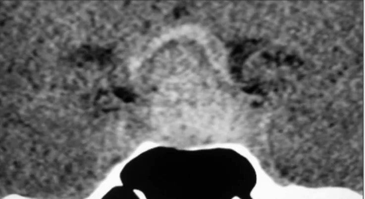 Fig 2. Note on this T1-weighted magnetic resonance imaging (coro- (coro-nal view) a sellar and suprasellar mass (adenoma) with a  hyperin-tense chronic hemorrhage.