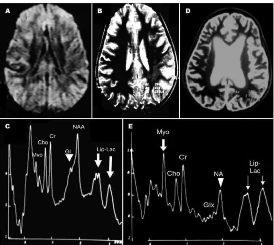 Fig 2. Case 2 – First MRI examina- examina-tion (A and B), three days after near  drowning, shows unremarkable  axi-al DWI (A) and axiaxi-al T2 (B)