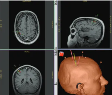 Fig 1. Magnetic resonance image (MRI) demonstrating the target  site for motor cortex stimulation.