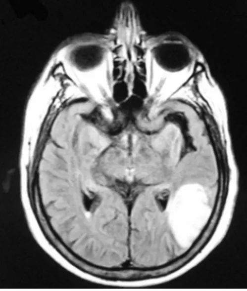 Fig 1. Contrast-enhanced  computed tomography of  the brain showing a left  tem-poral-occipital infarction in  development.