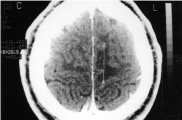 Fig 1.  Brain CT scan showing the tumor measuring 8 mm × 5 mm. Fig 2.  Area of cortical edema caused by the lesion.