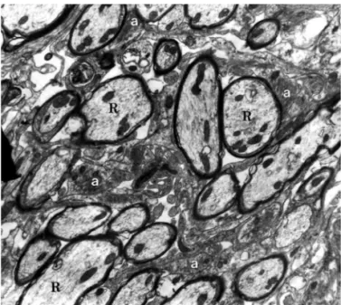 Fig 2. Group I - 31 days after EB injection. Oligodendrocyte remy- remy-elinated axons (R) associated with astrocytic processes (a)