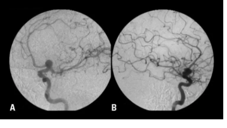 Fig 1. Cerebral angiographic  views showing a left carotid  bi-furcation aneurysm. Oblique [A] 