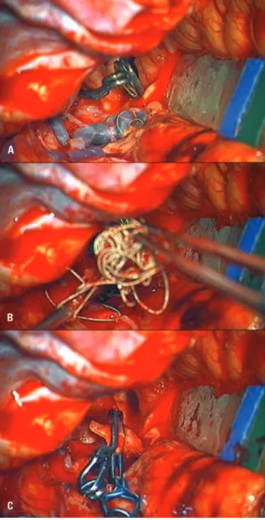 Fig 2. [A] Oblique angiographic view after coiling, showing com- com-plete occlusion of the aneurysm