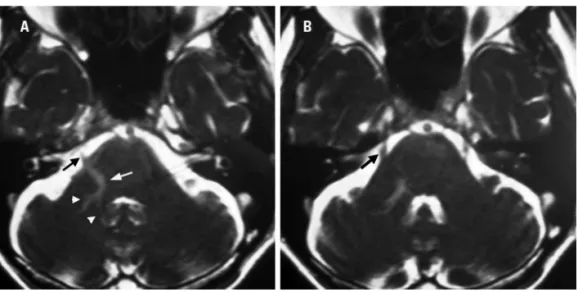 Fig 1. Sequential axial 3D CISS (three-dimensional constructive interference in steady state) MRI (1  mm width) reveals a large right transparenchymal vein (white arrow) and caput medusae (white  ar-row heads) [A] as well as the course of the trigeminal ne