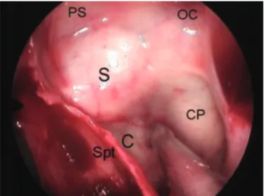 Fig 1. Endoscopic view of the sphenoidal sinus with the right side  partially covered by an intrasinusal septum [Spt]