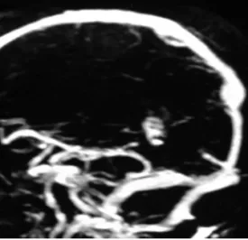 Fig 2.  MR venography showing the absence of  opaciication of the deep venous system.  Sagit-tal view.