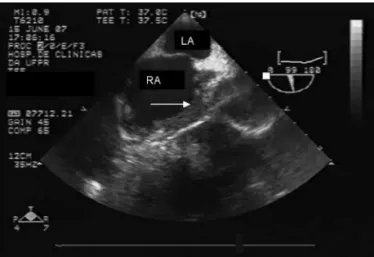 Fig 2. Transesophageal echocardiography demonstrating an inter- inter-atrial septum aneurysm characterized by a left atrium (LA)  interatri-al septum dislocation and a right atrium (RA) thrombus (arrows).