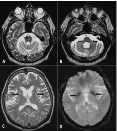 Table 1 depicts values of cerebral and midbrain struc- struc-tures according to clinical diagnosis