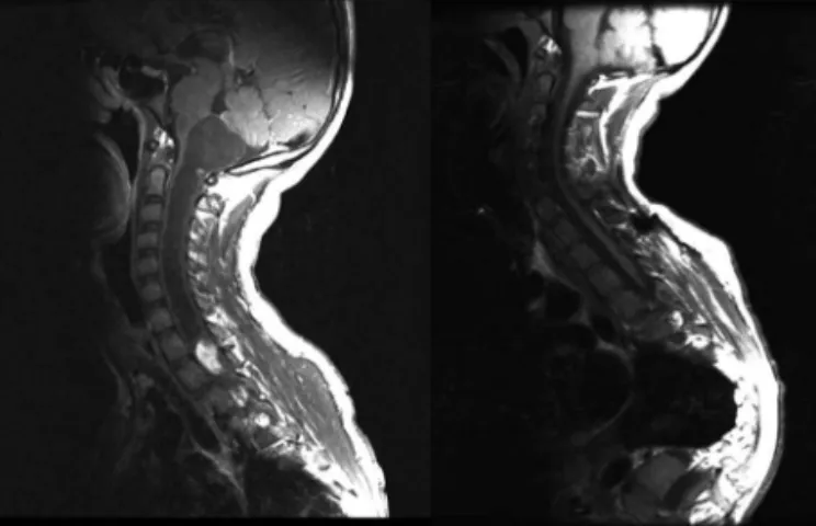 Fig 1. Preoperative and postoperative MRI showing total resection  of the tumor in the cervical spinal cord.