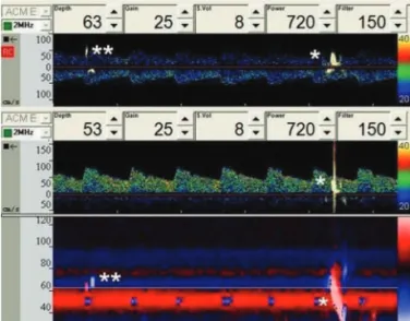 Fig 1. A positive embolus track (ET) (*) in the left middle cerebral  artery is visualized in both spectral gates (depth=63 mm and 53  mm) and the M-mode, and an anterior cerebral artery ET (**) is  vi-sualized only on the proximal spectral gate (depth=63 
