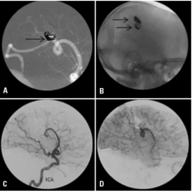 Fig 1. Lateral internal carotid artery (ICA) injection in early [A] and  late [B] phases showing a high-low AVF draining to a dilated vein,  and then to the sigmoid sinus