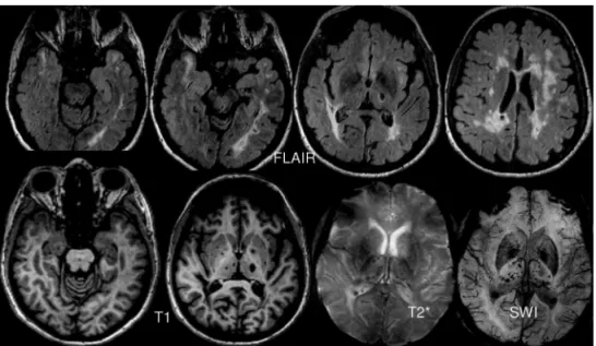 Fig 2. Magnetic resonance imaging in CADASIL in a 62-year old woman with multiple strokes and  dementia (courtesy of Dr