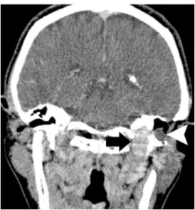 Fig 1. Contrast-enhanced coronal HRCT scan  shows an intensely enhancing mass (arrow),  ex-tending to the middle ear and producing  ero-sion of left jugular foramen