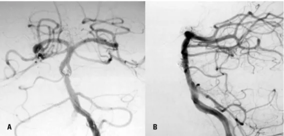 Fig 3. Post- embolization angiogram showing complete occlusion of the aneurysms. [A] Frontal view