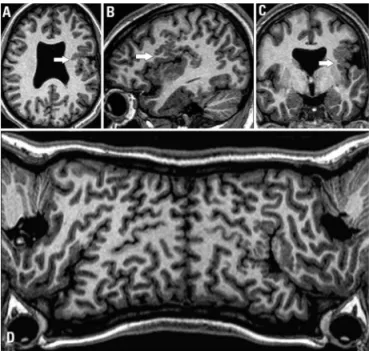 Fig 2. T1-weighted isotropic MPRAGE sequence with reconstruc- tion in the axial [A], sagittal [B], coronal [C] and curved  reconstruc-tion [D] show was an extensive area of cortical malformareconstruc-tion on  the left Sylvian issure, involving the insula,