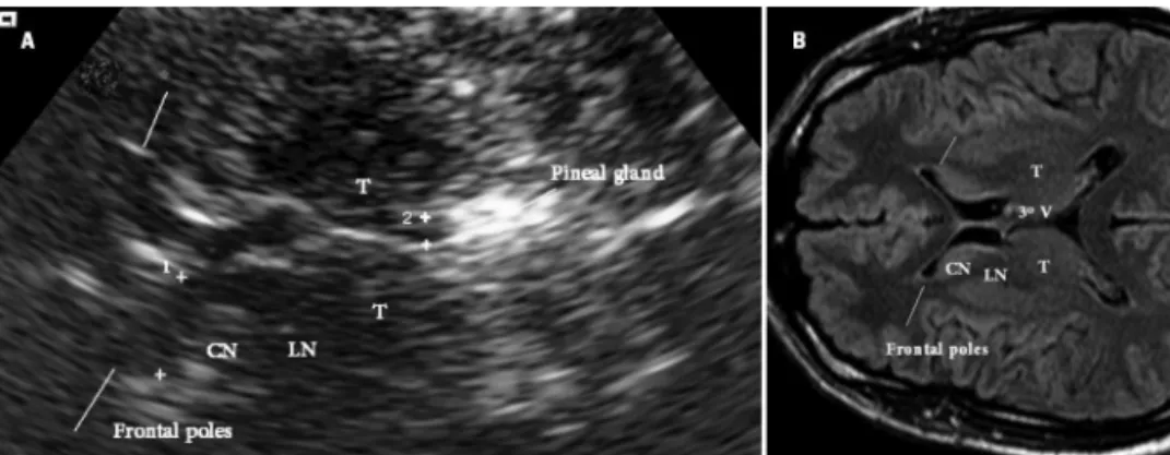 Fig 2.  Ventricular and basal ganglia plane images on Transcranial Sonography (TCS) and Mag- Mag-netic Ressonance (RM)