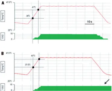 Fig 6. Long painful stimulation. Note the lower thermal thresh- thresh-olds of illustrative patient [B] in comparison with a control  sub-ject [A]