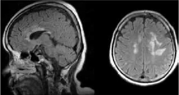 Fig 1. MRI Brain lesions in a patient with NMO. The initial symptom 