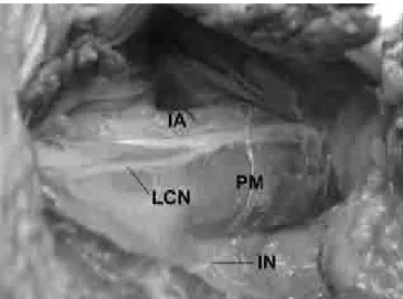 Fig 2. Surgical view of the retroperitoneal space after muscle  layers section and medial displacement of the abdominal  con-tent
