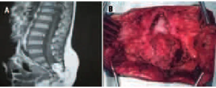 Fig 4. [A] T1-weighted MRI showing caudal lipoma penetrating  the dura mater, with adherence to the medullary conus, which  was located in an abnormally low position, and syringomyelia of  the conus