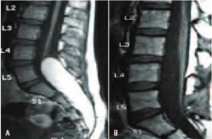 Fig 5. [A] Sagittal preoperative T1-weighted MRI showing large  lipoma tethering the spinal cord