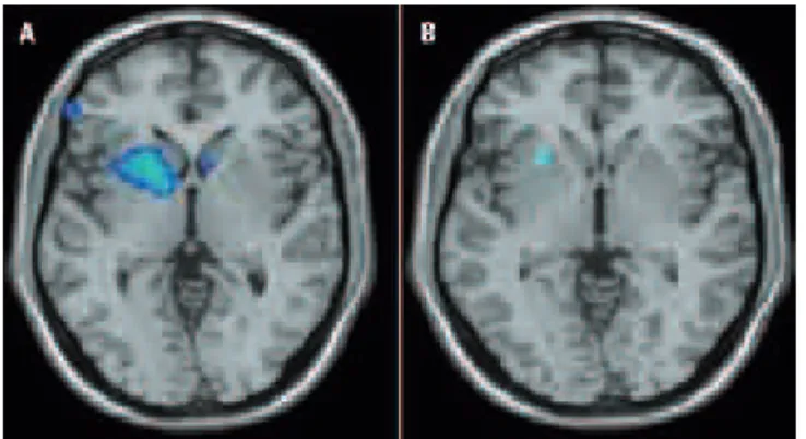 Fig 2. Brain SPECT SPM results in a patient with stroke before func- func-tional electrical stimulation [A] with 2294 voxels and after  stimu-lation [B] with 8812 volts