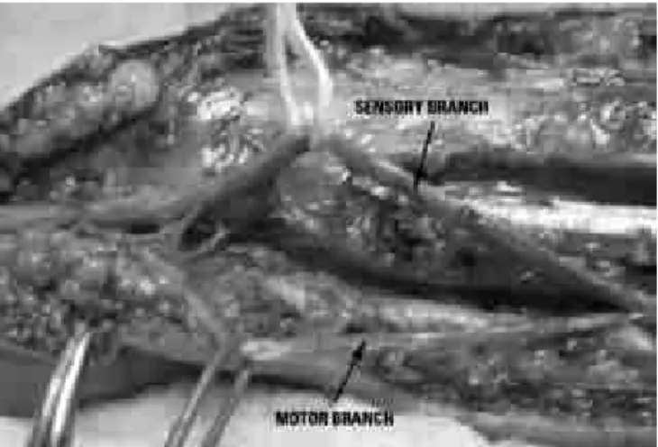 Fig 2. Operative photograph to the level of the distal forearm: 