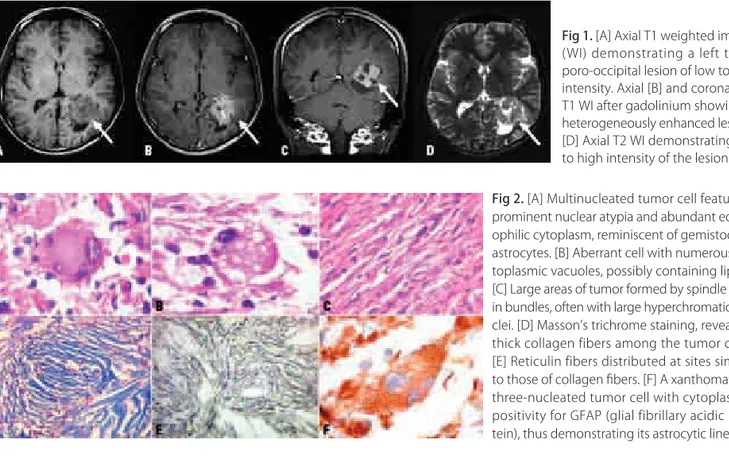 Fig 2.  [A] Multinucleated tumor cell featuring  prominent nuclear atypia and abundant  eosin-ophilic cytoplasm, reminiscent of gemistocytic  astrocytes