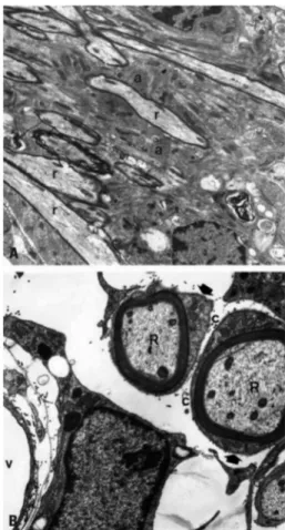 Fig 1.  Group I - Electronmicrographs [A] Oligodendrocyte  remyelinated axons (r) next to astrocyte processes (a)