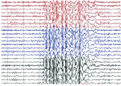 Fig  1. Ictal  video-EEG  re- re-cord showing epileptogenic  activity characterized by a  spike-wave discharge of 4HZ  with bilateral projection (3  seconds interval) and anterior  prevalence after eye closed  in bright ambient associated  with eyelid mioc