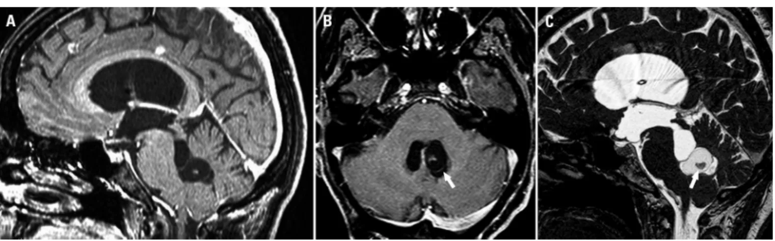 Fig 2. Case 2. Axial enhanced SPGR [A] dem- dem-onstrates a cystic lesion in the third ventricle