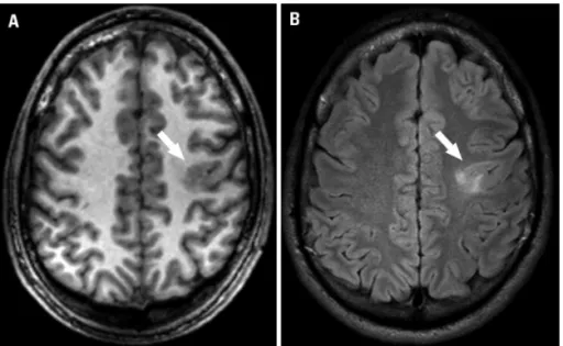 Fig 1. Focal cortical dysplasia. MRI performed  at 3 Tesla exhibit an area of mild cortical  thickening, with blurring of the white-gray  matter interface in the left frontal lobe in the  T1 FFE (fast ield echo) axial image (arrow in  A), that is also visu