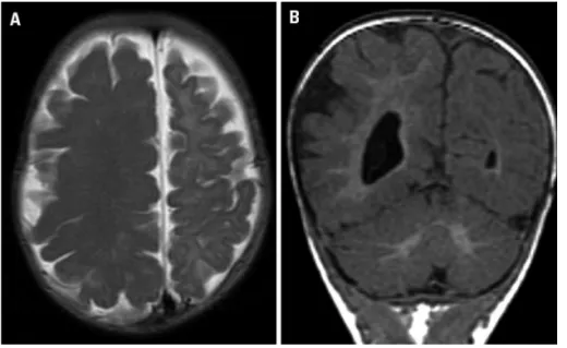 Fig 2. Hemimegalencephaly. Axial T2 FSE  (fast spin echo) [A] shows an enlarged right  cerebral hemisphere