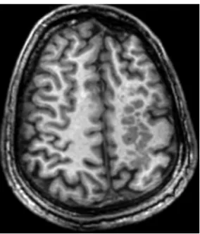 Fig 3. Periventricular nodular heterotopia. Volumetric T1 FFE (fast  ield echo) sequence performed at a 3 Tesla scanner with axial  reconstruction in thin sections (1 mm thick) shows  subependy-mal heterotopic gray matter adjacent to the right lateral  ven